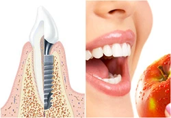 les avantages des implants dentaires