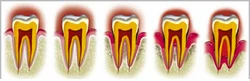recession gingivale